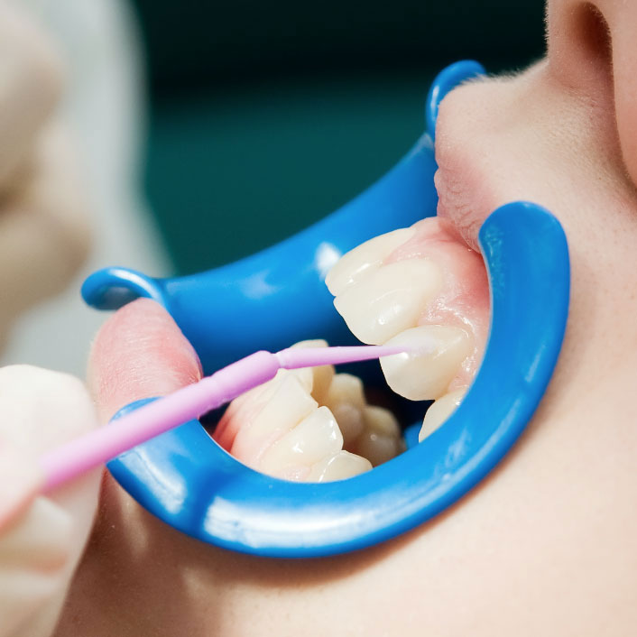 Protect Your Smile with Dental Sealants from Vela Dental Centers
