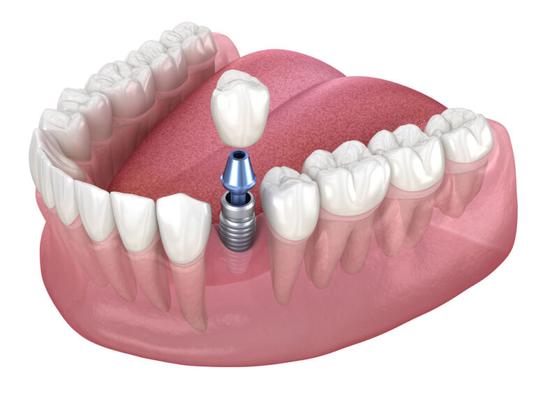 dental implants