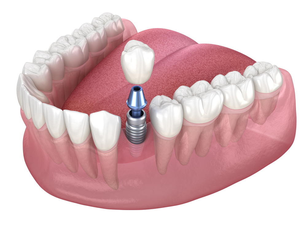 dental implants